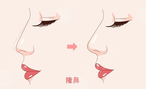 隆鼻整形案例