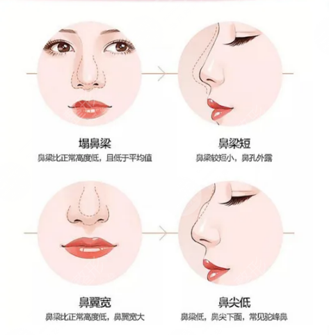 隆鼻整形术后