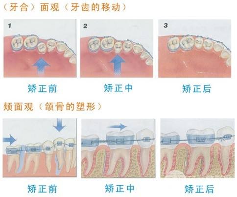 深圳北大医院口腔正畸科医生科普