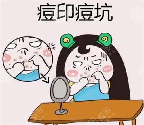 激光祛痘