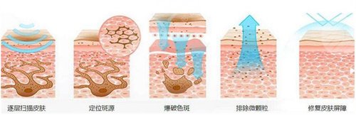 激光祛斑