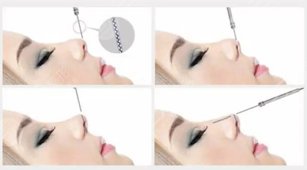 耳软骨隆鼻整形