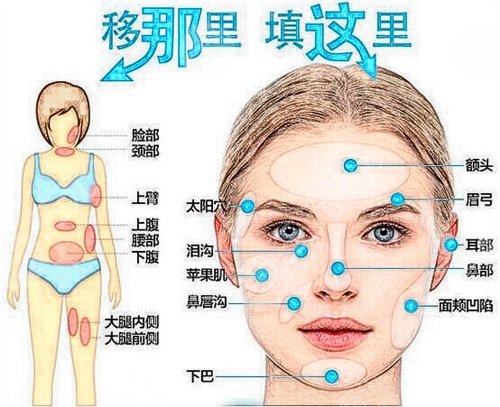 赵希军自体脂肪填充除皱案例