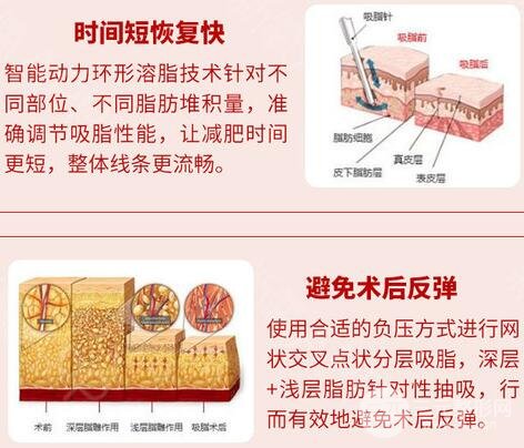 吸脂减肥注意事项