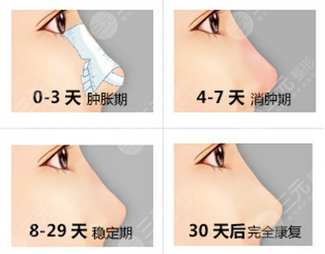 肋软骨隆鼻案例