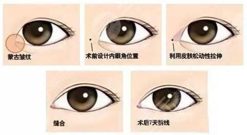 微创双眼皮案例