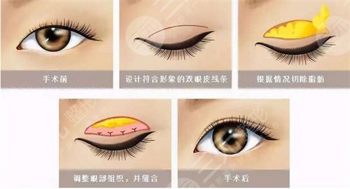李斌斌双眼皮案例