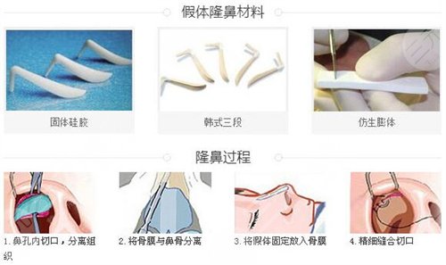 隆鼻案例欣赏