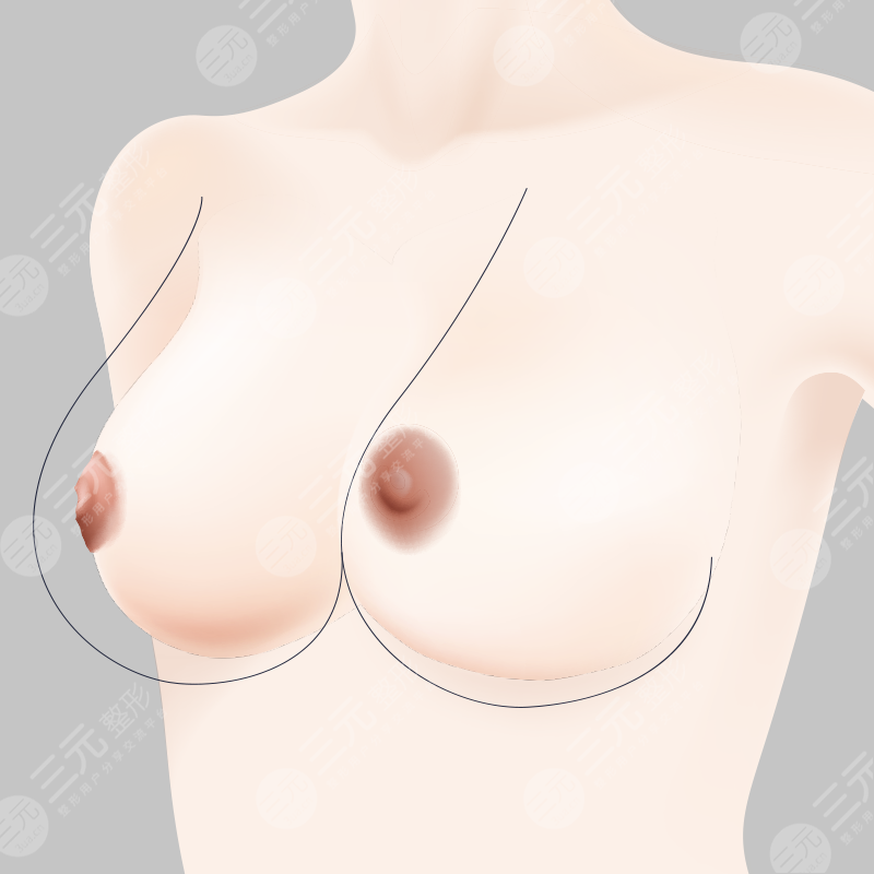 巨乳缩小术果