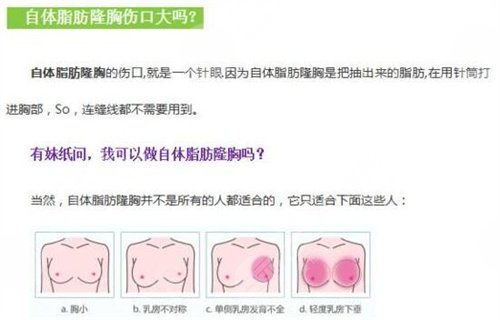自体脂肪填充