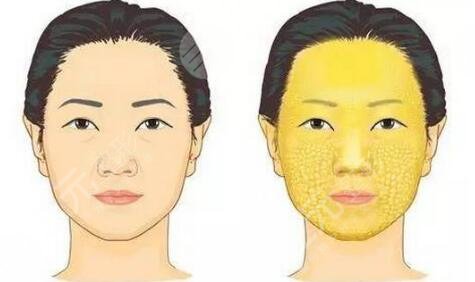 脂肪填充全脸后的脂肪会被吸收完吗?