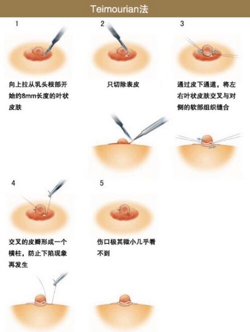 安庆市立医院整形外科做乳头内陷价格,并附上真实案例~-城市惠整形