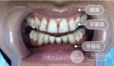 重庆协尔口腔洗牙