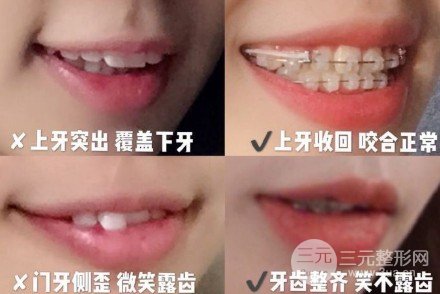 广州雅度口腔矫正牙齿