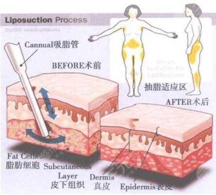 惠州瑞芙臣医疗美容诊所价格表全览附吸脂案例果对比
