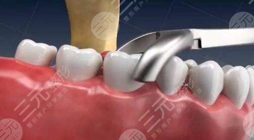 牙齿种植