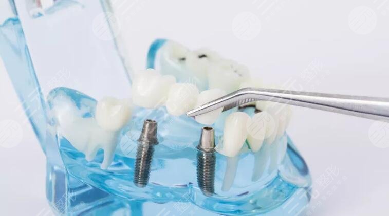 牙齿种植的没问题性高吗?