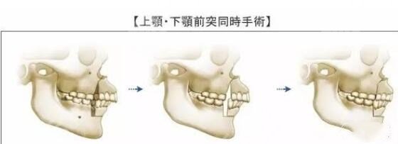 什么是正颌手术