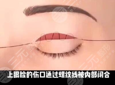 全切双眼皮