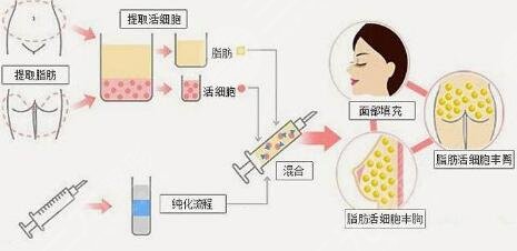 脂肪填充全脸导致面部下垂的原因有哪些?