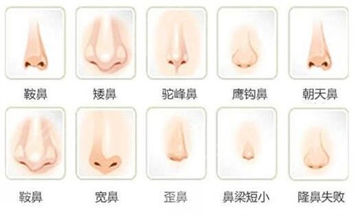 北京隆鼻手术要多少钱|隆鼻整形真人案例对比图
