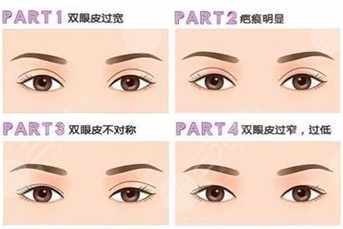 信阳东方艺员工双眼皮手术术前果