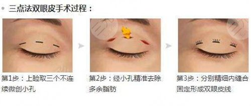 信阳东方艺切开双眼皮真人案例手术中