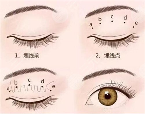 信阳东方艺全切双眼皮真实经历