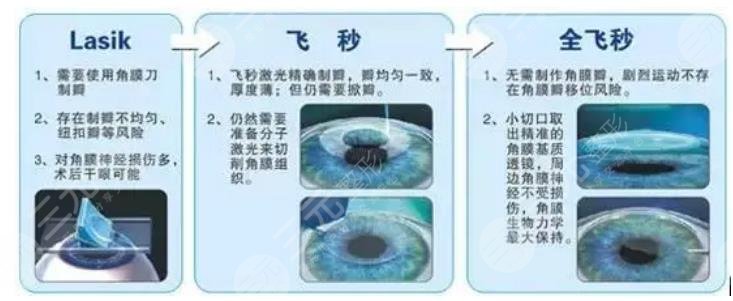 屈光矫正技术