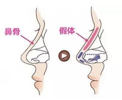 浙一医院割双眼皮价格多少钱？吴慧玲VS叶秀娣，案例图大公开！