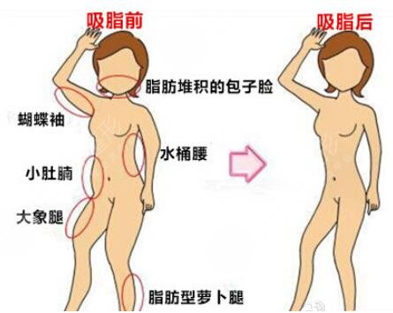 深圳南雅医疗美容好不好？价格表/人气医生介绍/手臂吸脂案例~