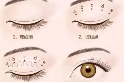 埋线双眼皮手术之后需要注意什么?
