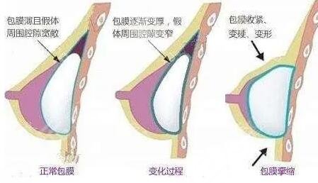 硅胶隆胸有危害吗?