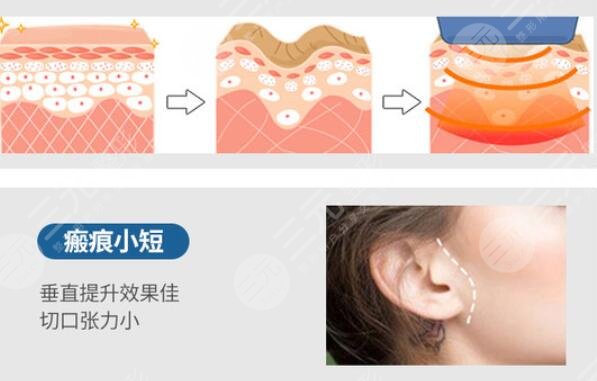 北京八大处拉皮整形科热门项目