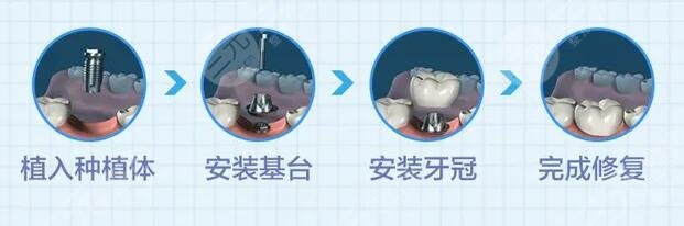 牙齿种植
