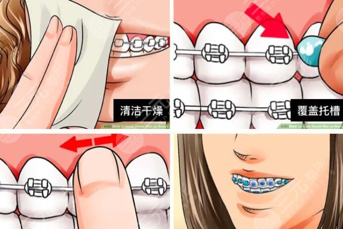 牙齿矫正可怕吗