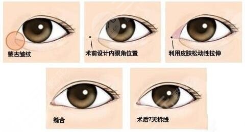 双眼皮整形+开眼角整形手术过程