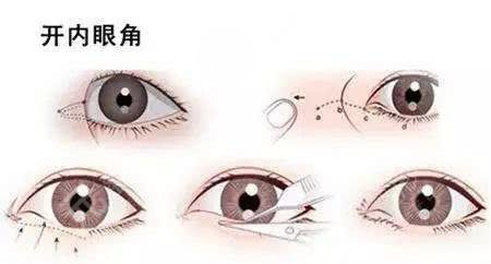 开内眼角多少钱?风险大吗?优缺点|适合人群|注意事项盘点~