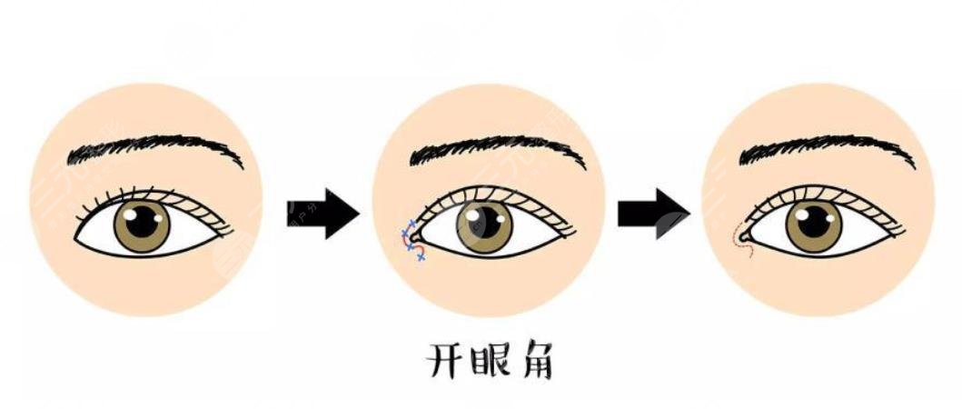 影响开内眼角价格因素