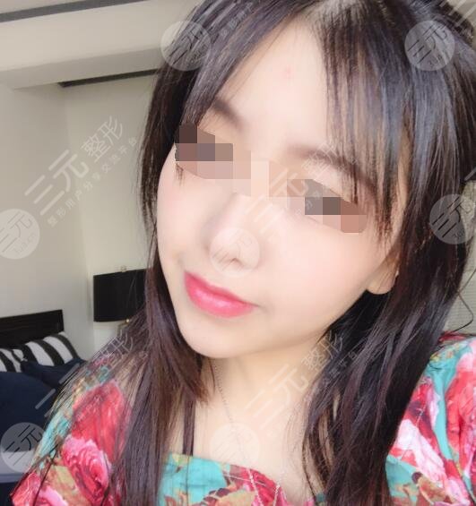 激光除皱案例术后