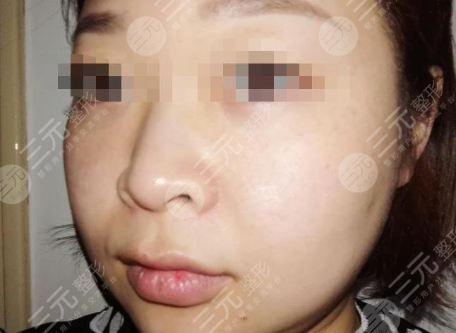 做祛斑手术之后