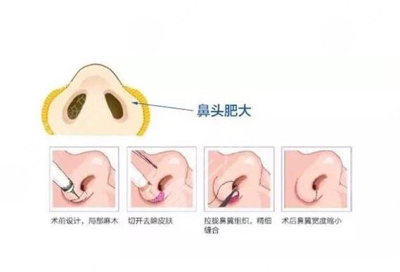 影响鼻翼缩小手术价格的因素