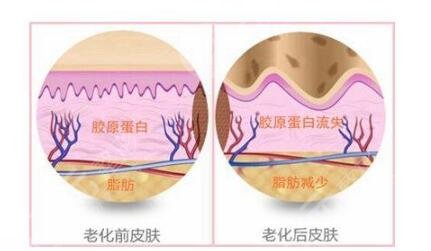 嗨体除皱术前需要注意什么呢