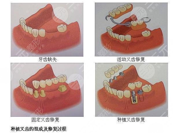 镶牙影响价格的因素