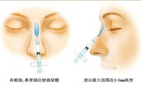玻尿酸隆鼻能保持多久