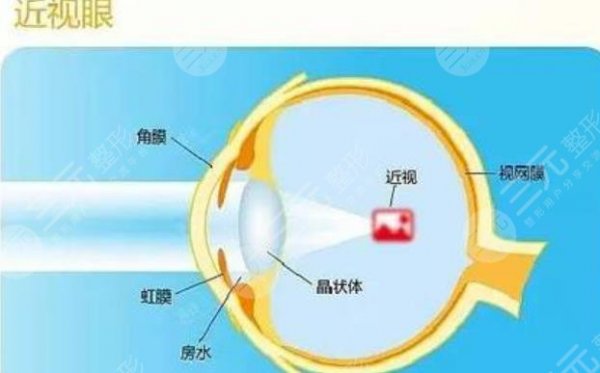 北京做近视眼手术的价格一般是多少钱？2023参考价&术前科普攻略分享！