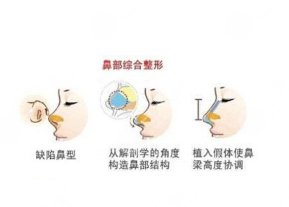 戴传昌医生针对做鼻子项目相关知识科普