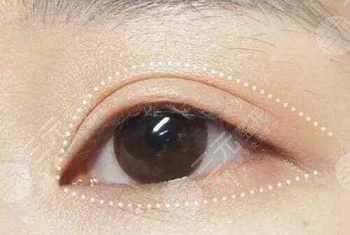 北京八大处整形医院眼部项目科普