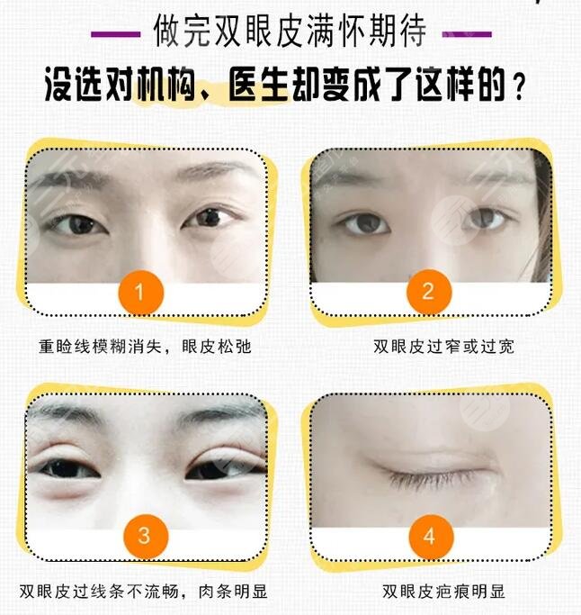 双眼皮修复术前准备什么