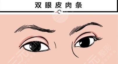 双眼皮修复术后注意什么